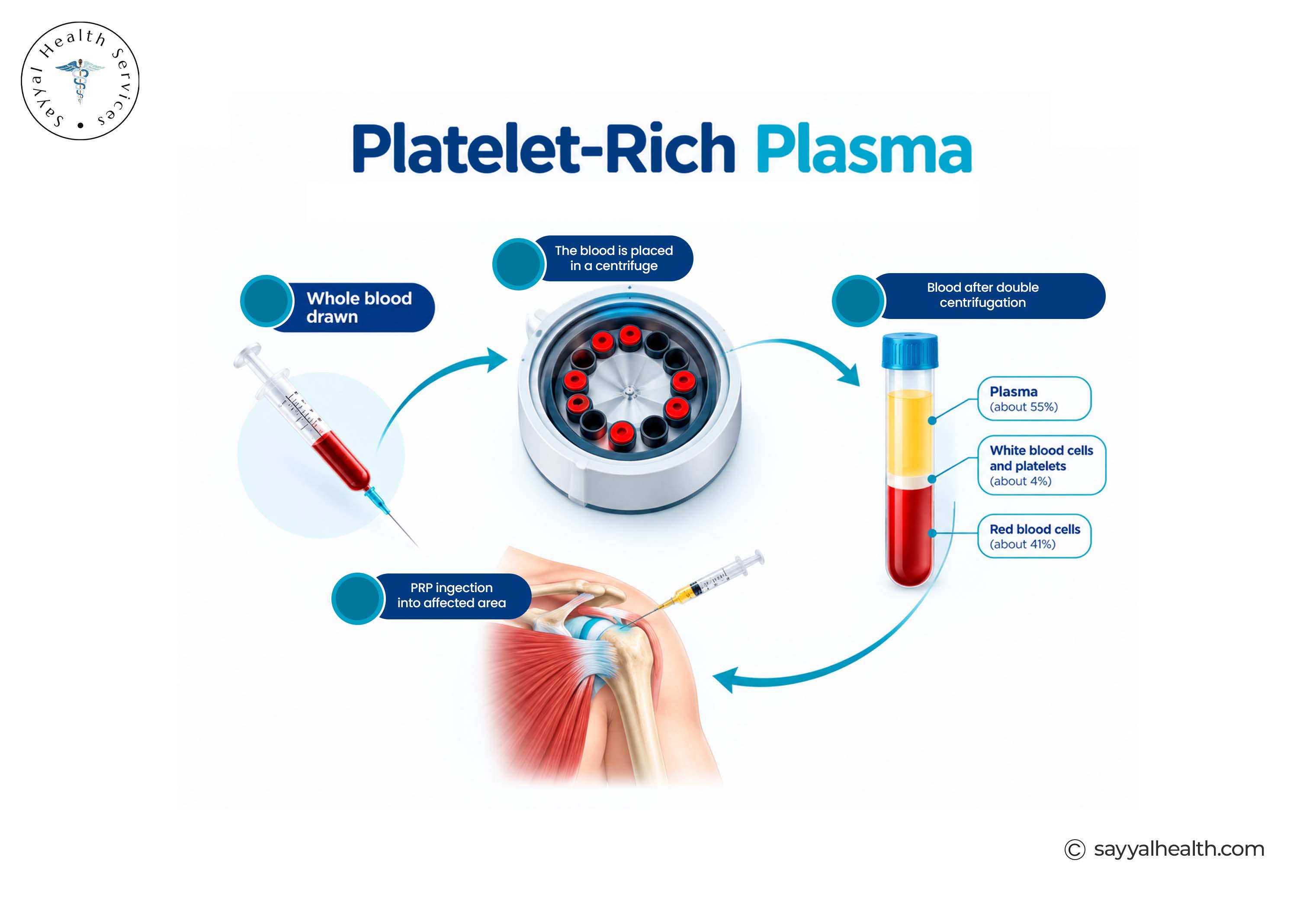 platelet rich plasma